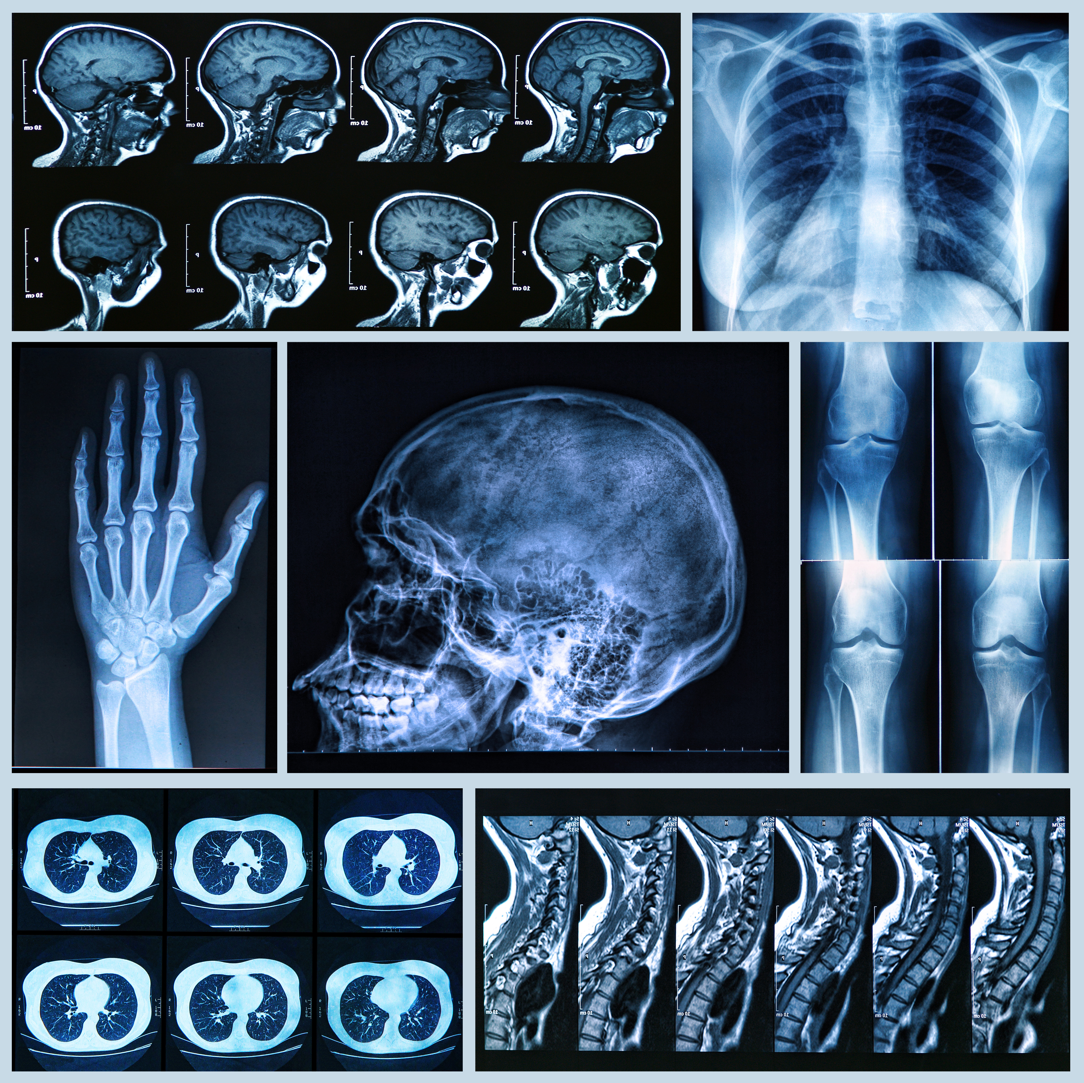 Radiography of Human Bones